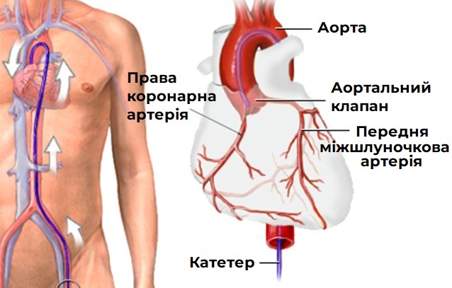 коронарна-ангіографія