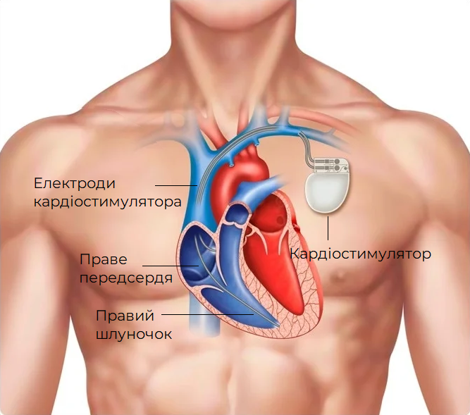 кардіостимулятора схематичне зображення