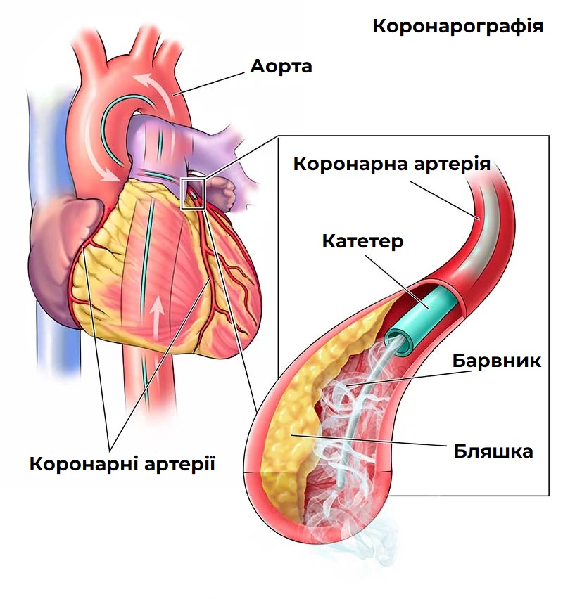 коронарна-ангіографія