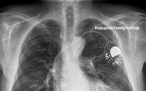 кардіостимулятор