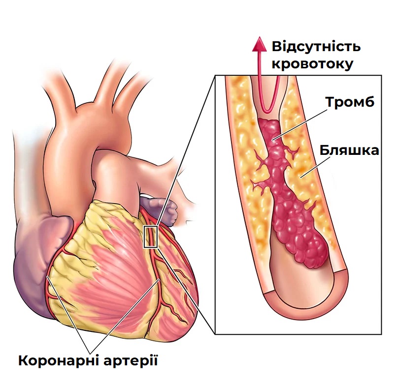 Забиті-судини