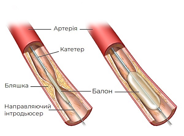 An inserted balloon catheter inflates to open blocked blood vessel; PCardio_20140402_v0_001

SOURCE: pickup from cardio_peri-vasc-angiopl_proc_3a;