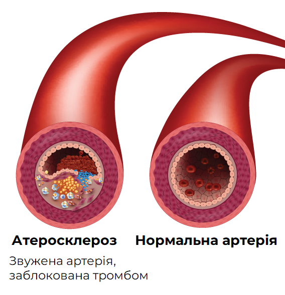 атеросклероз