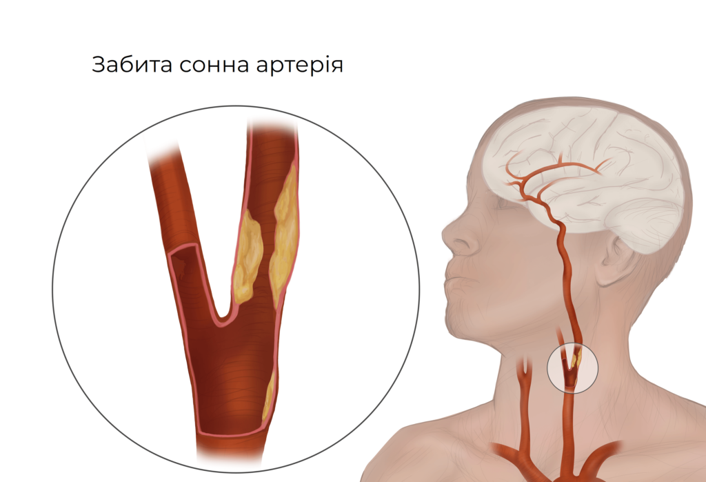 коронарні артерії