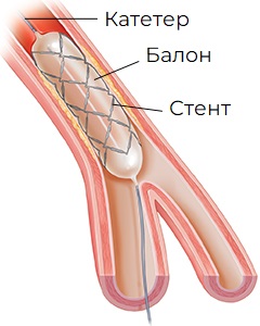 балон стент