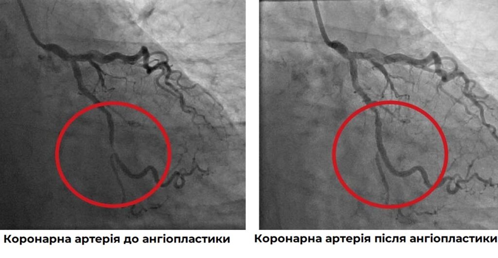 артерія після ангіопластики