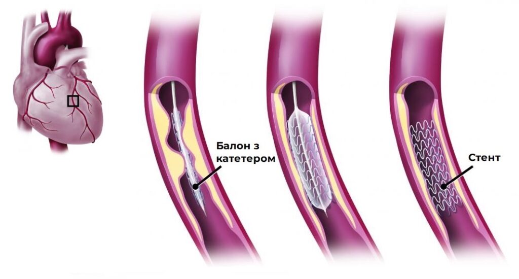 коронарних артерій