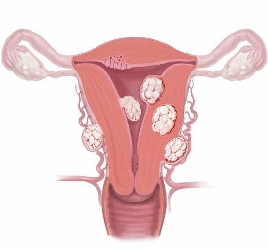 vuzlova fibromioma matky 6