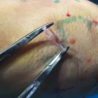 Варикозне розширення вен